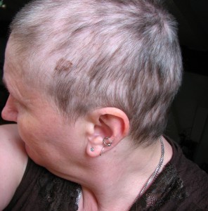 Diffuser Haarausfall