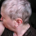Diffuser Haarausfall