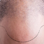 Haartransplantation Erfahrungen von Serdar