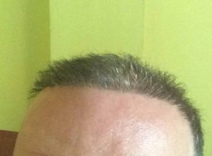 Haartransplantation Türkei Erfahrungen - Dr. balwi