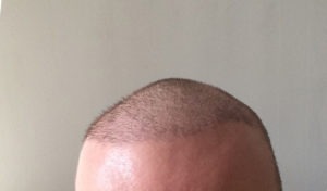 Meine Erfahrungen mit der Haartransplantation in der Türkei bei Dr. Balwi
