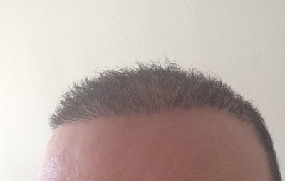 Haartransplantation FUE-Methode Erfahrungen Istanbul