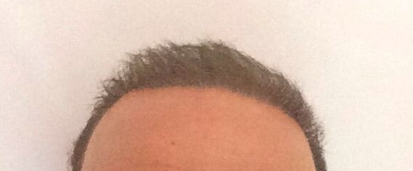 Haartransplantation in der Türkei bei Elithairtransplant