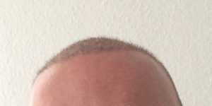 Haartransplantation in der Türkei - Meine Erfahrungen