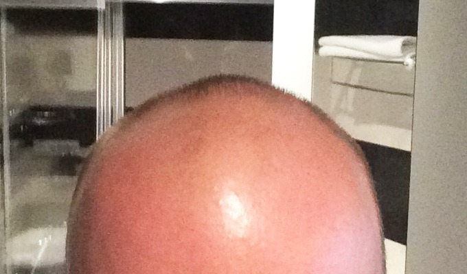 Meine Haartransplantation in der Türkei bei Dr. Balwi und meine Erfahrungen