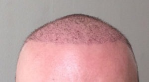 Haartransplantation in der Türkei - Meine Erfahrungen