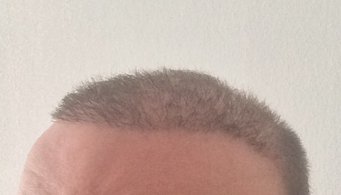 Haartransplantation Erfahrungen - Erfahrungsbericht Dr. Balwi