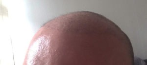 Haartransplantation in der Türkei Erfahrungen