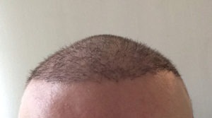 Haartransplantation Türkei Erfahrungen Dr. Balwi