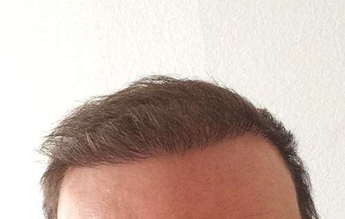 Haartransplantation Türkei Erfahrungen bei Dr. Balwi