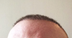 Meine Erfahrungen mit der Haartransplantation in der Türkei bei Dr. Balwi