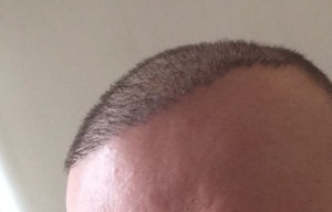 Haartransplantation in der Türkei - Mein Erfahrungs-Bericht mit Dr. Balwi