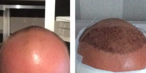 Michael's Haare vor und nach der Haartransplantation