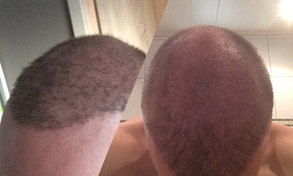 Haartransplantation Türkei Erfahrungen Elithairtransplant