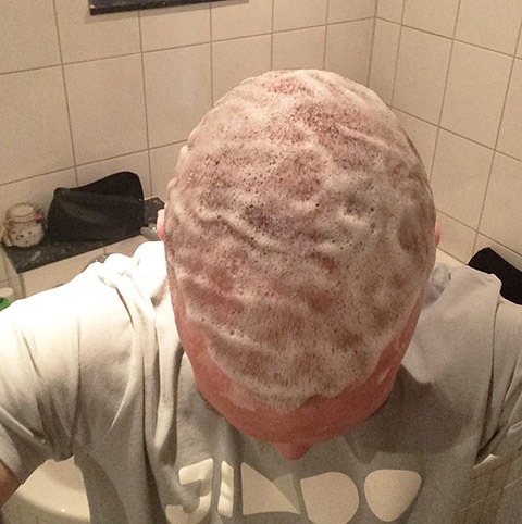 Meine Erfahrungen mit der Haartransplantation in der Türkei