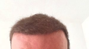 Haartransplantaton Türkei Erfahrungen Dr. Balwi - Elithairtransplant