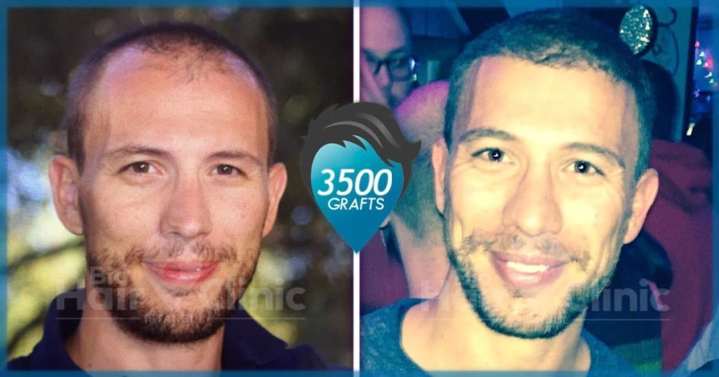 Bio Haartransplantation - Erfahrungen & Kosten