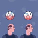 Der Prozess einer Haartransplantation in 4 Schritten