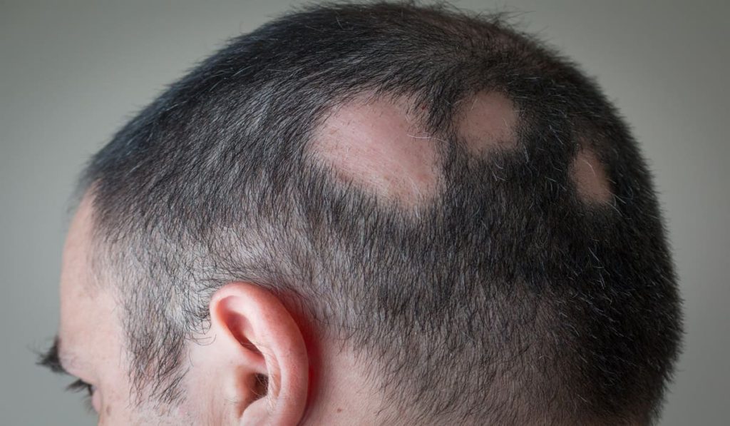 Haarausfall Symptom oder Krankheit - kreisrunder Haarausfall
