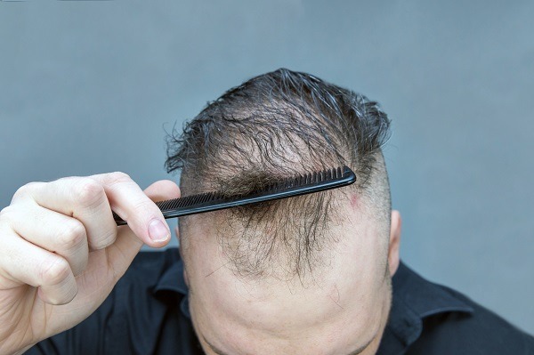 Haarausfall Symptom oder Krankheit - bei Männer