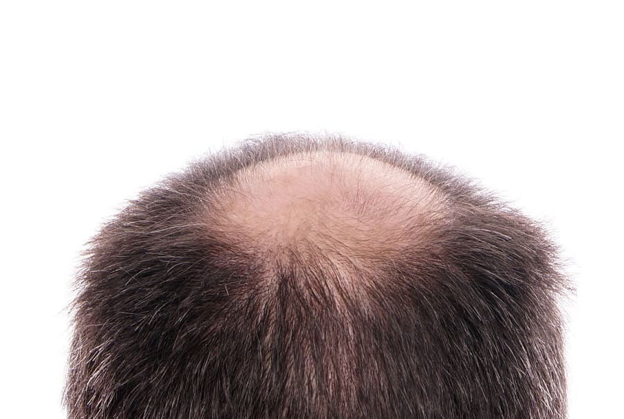 Androgenetischer Alopezie bei Männern