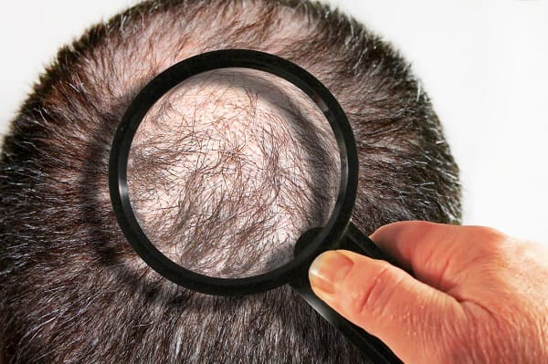 Beweggründe für eine Haarverpflanzung - Untersuchung