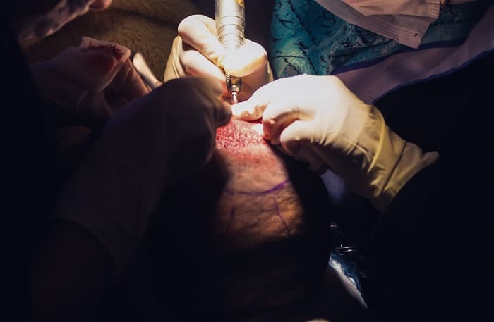 Beweggründe für eine Haarverpflanzung - Haartransplantation als Methode