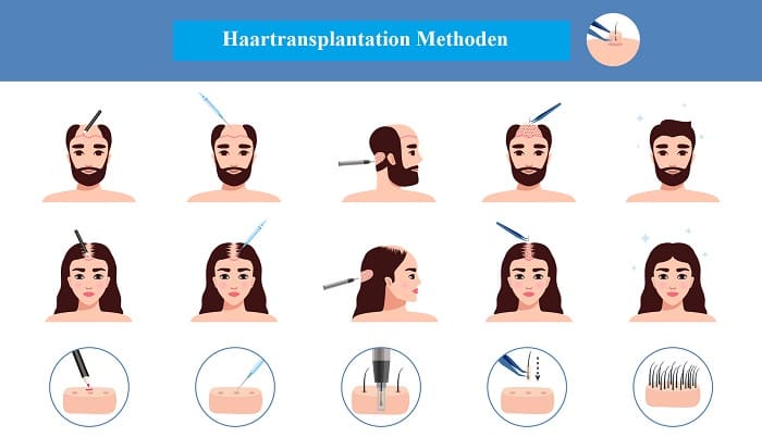 Haartransplantation im Ausland - moderne Methoden