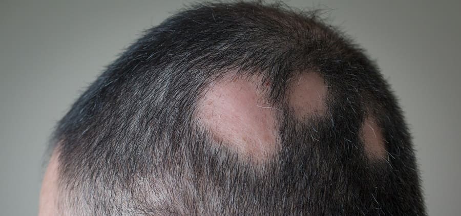 Was sind die Ursachen für kreisrunden Haarausfall