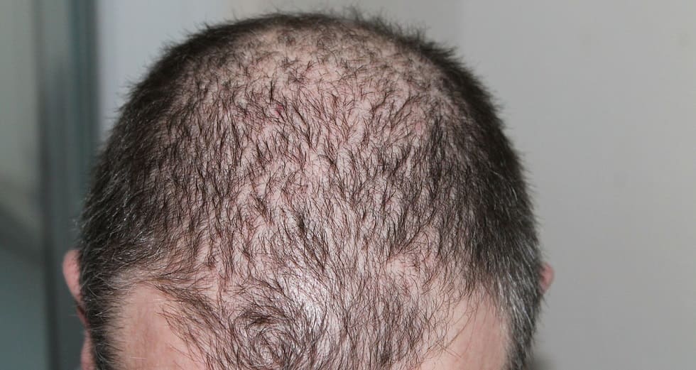 Haartransplantation bei hoher Stirn