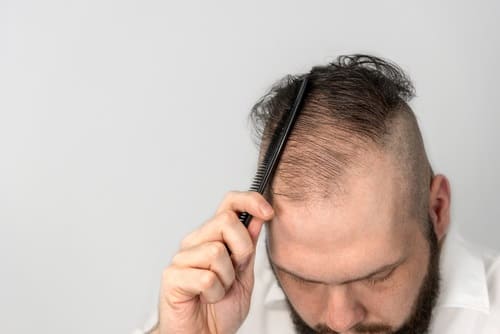 Gründe für den Haarausfall - Haartransplantation als Lösung