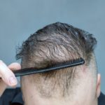 Haarausfall durch Chemotherapie