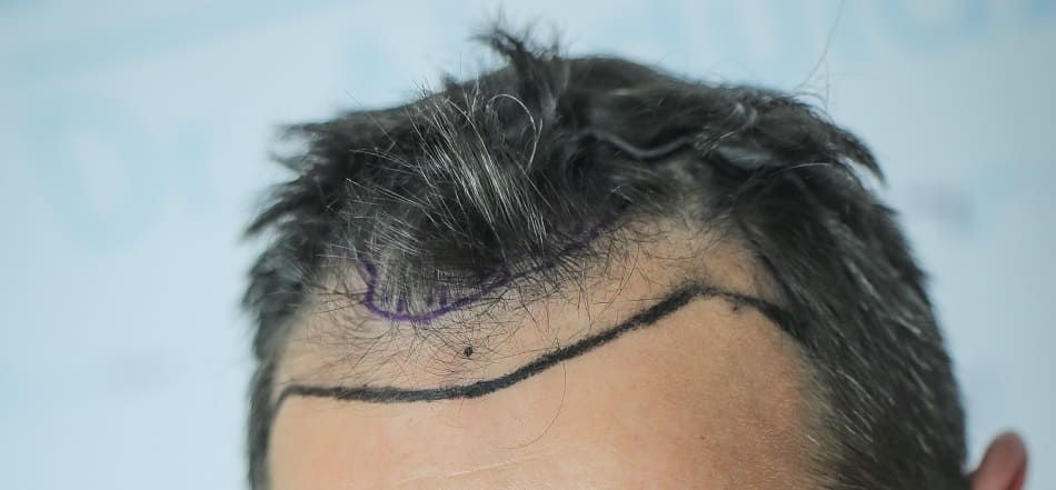 Haartransplantation Haarlinie ästhetisch gestalten