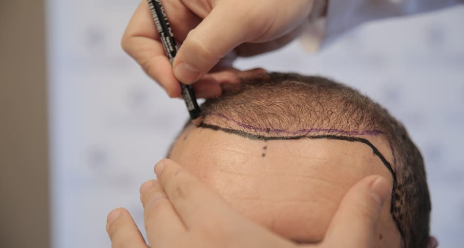 Haartransplantation Haarlinie