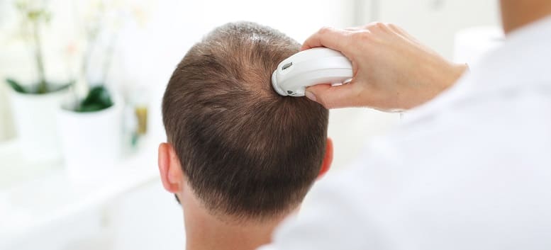 Behandlungen und Therapie bei Haarausfall