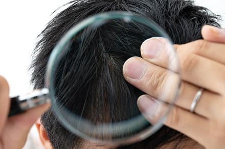 Einseitiger Haarausfall - Ursachen finden