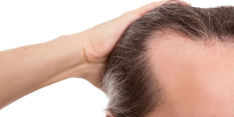 Erblich bedingter Frontaler Haarausfall