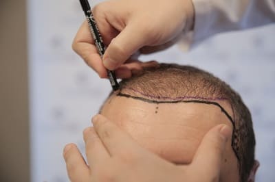 Haartransplantation Haarlinie zeichnen