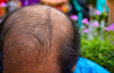 Verlust der Haare eine Krankheit