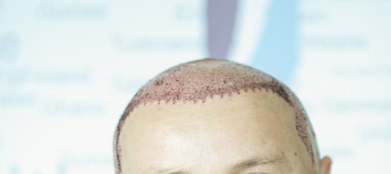 Attraktiv trotz Haarausfall - Haartransplantation dauerhafte Lösung bei Haarausfall Geheimratsecken