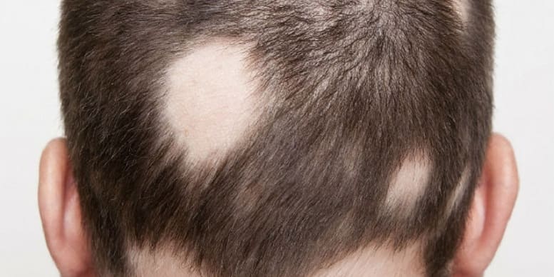 Haare Diagnose - Kreisrunder Haarausfall