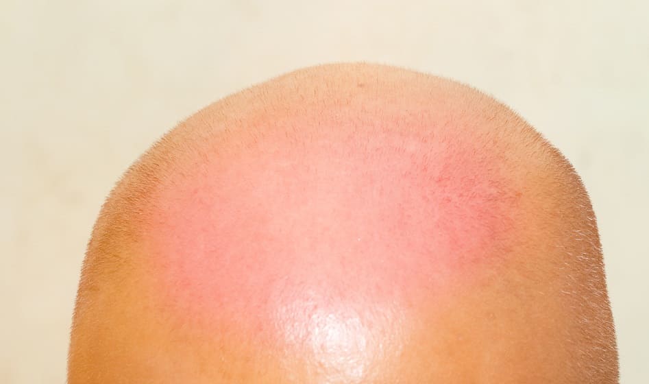 Haarausfall Sonnenbrand auf Kopfhaut