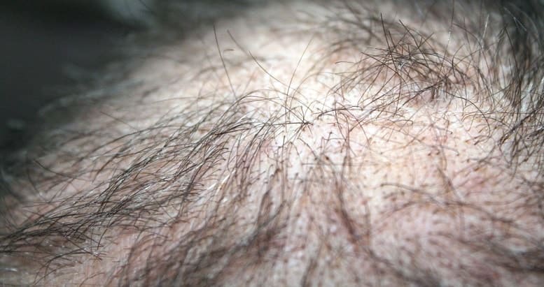Haarausfall rückgängig - Übersäuerung der Kopfhaut