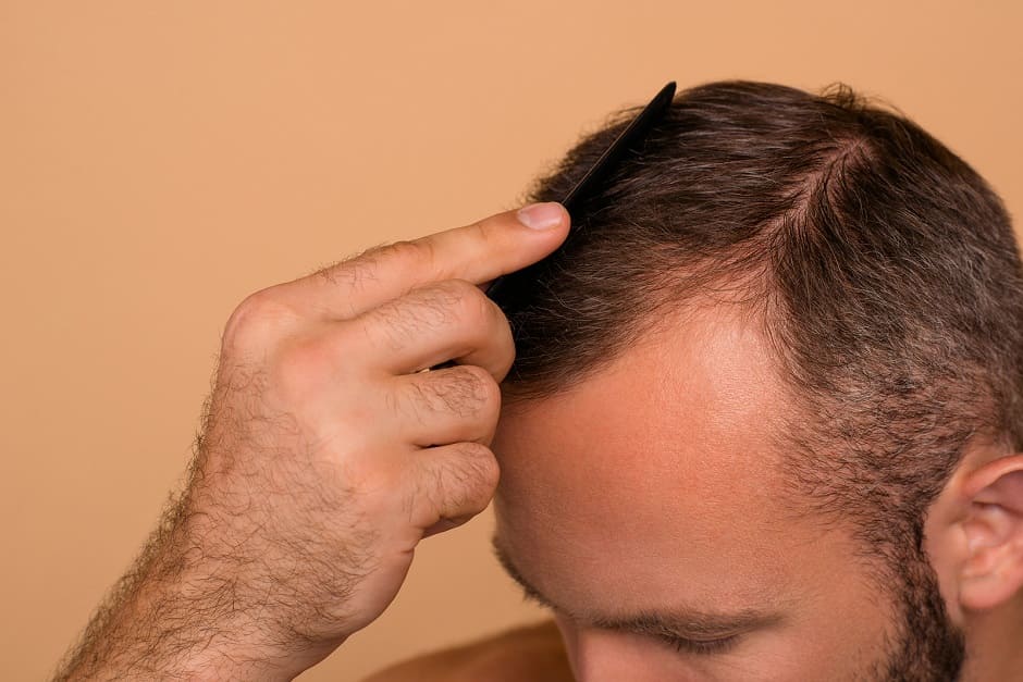 Mann kämmt die Haare zur Seite und demonstriert seinen Haarausfall