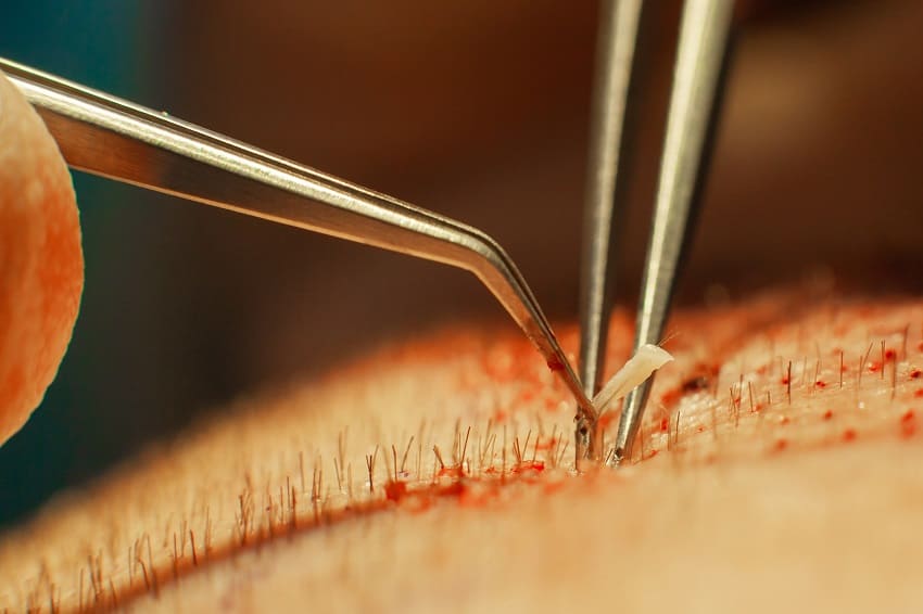 Waehrend einer Haartransplantation wird ein Graft eingesetzt