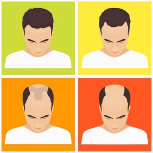 Erblich-bedingter Haarausfall Männer