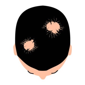 kreisrunder Haarverlust