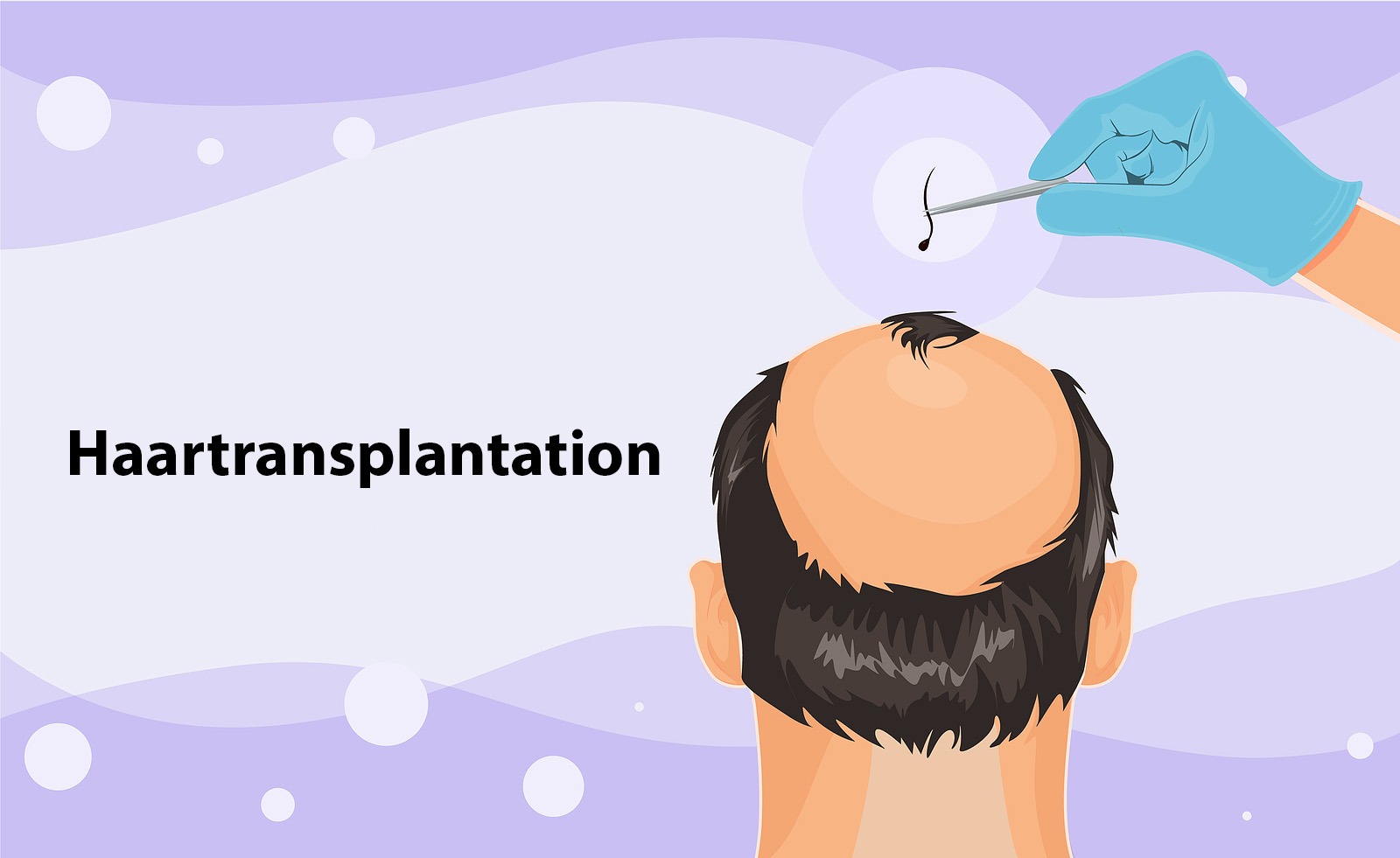 Haartransplantation