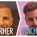 Haartransplantation in der Türkei - die Erfahrung von Mike