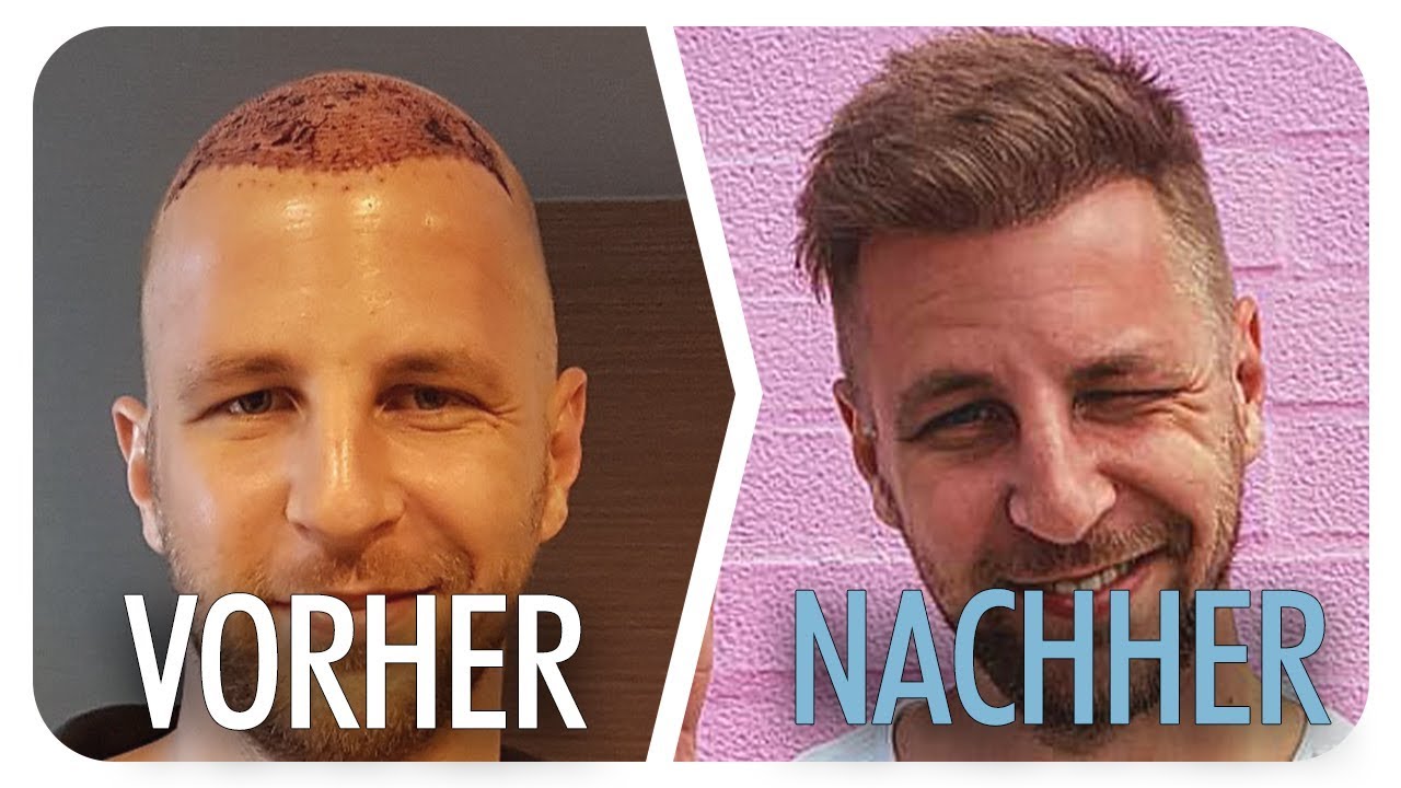 Haartransplantation in der Türkei - die Erfahrung von Mike